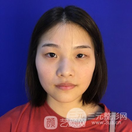 成都米蘭柏羽康春雨鼻部手術(shù)案例恢復(fù)日記~